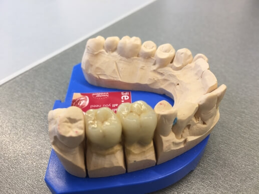 Ábra a hídpótlásról.